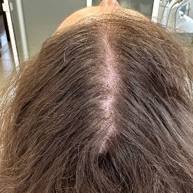 До проведения курса плазмотерапии волос в сочетании с домашним уходом, подобранным врачом-трихологом (июль 2023 год)