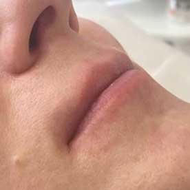 До процедуры увеличения губ гиалуроновой кислотой
