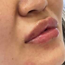 После процедуры увеличения губ (врач Слизовская Виктория Григорьевна)