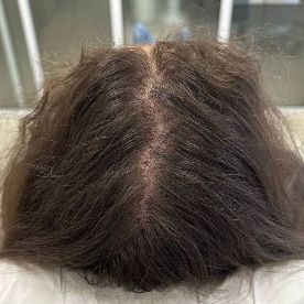 После проведения курса плазмотерапии волос в сочетании с домашним уходом, подобранным врачом-трихологом (октябрь 2023 год)