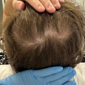 После проведения курса плазмотерапии волос в сочетании с домашним уходом, подобранным врачом-трихологом (сентябрь 2023 год)