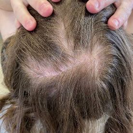 До проведения курса плазмотерапии волос в сочетании с домашним уходом, подобранным врачом-трихологом (апрель 2023 год)