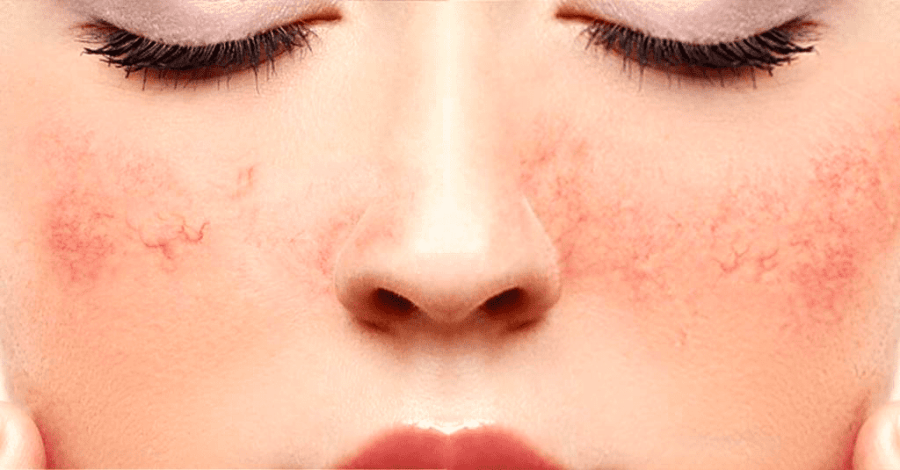 Купероз кожи лица: что это такое, причины и симптомы, способы лечения