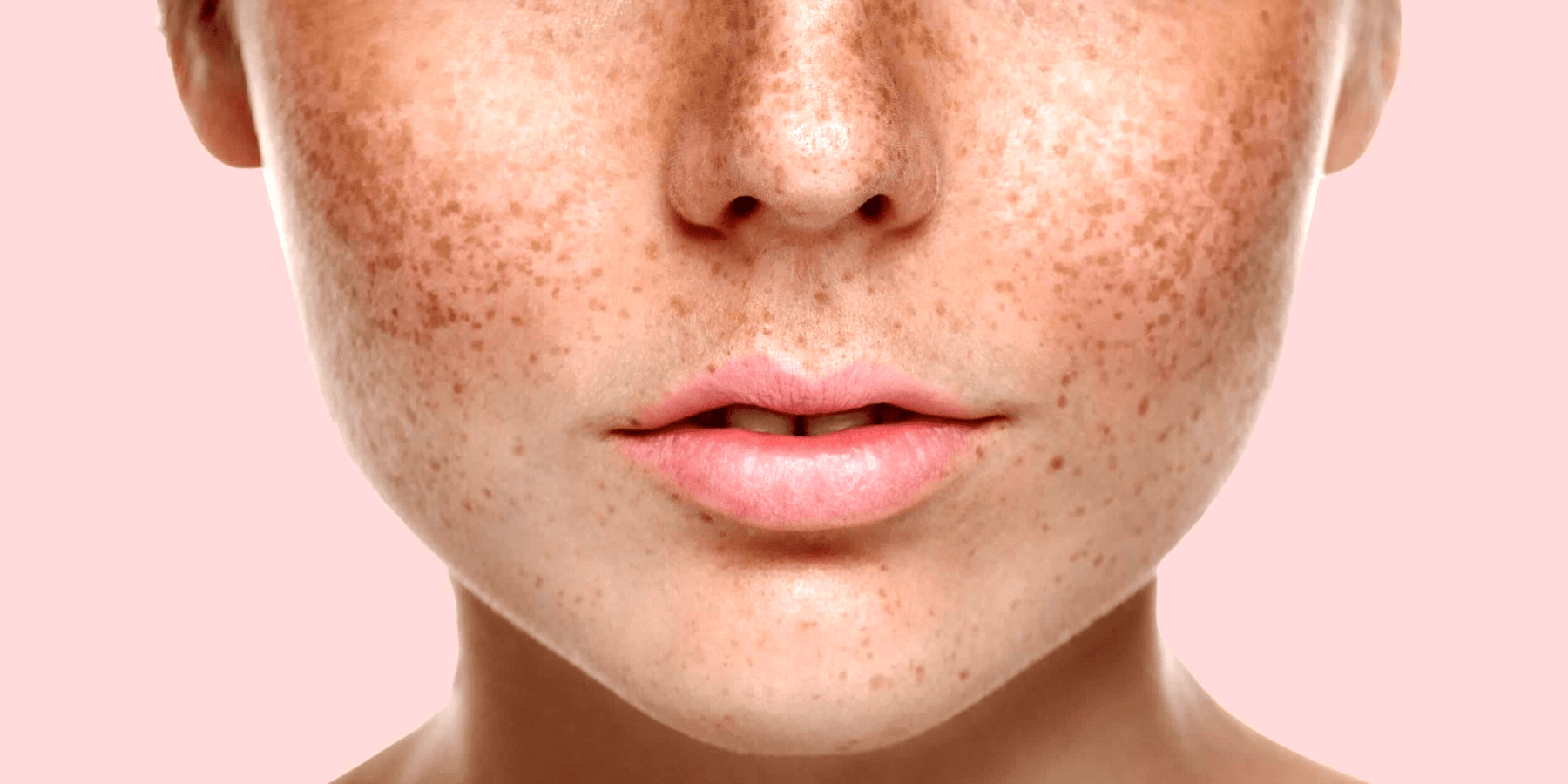 Причины пигментации кожи и способы борьбы с ней